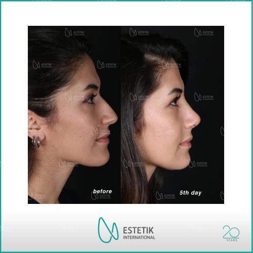 عملية تجميل الأنف صور قبل وبعد